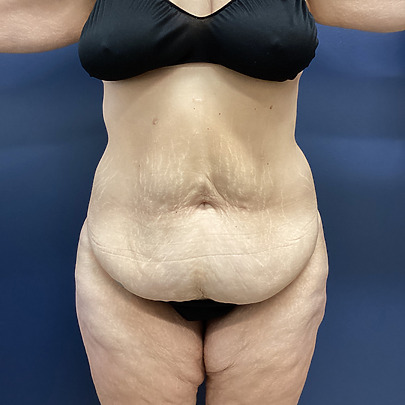 Person in black bikini against a blue background, arms slightly raised, showing abdominal area.