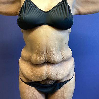 person with loose abdominal skin in a dark bikini standing against a blue background with arms outstretched