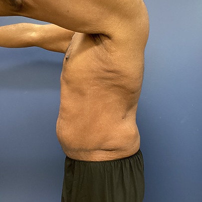 Side view of a man standing against a blue wall showing his upper body after abex excess skin removal surgery
