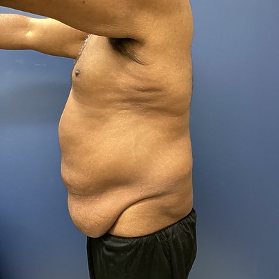 Sono Bello patient before abex excess skin removal procedure