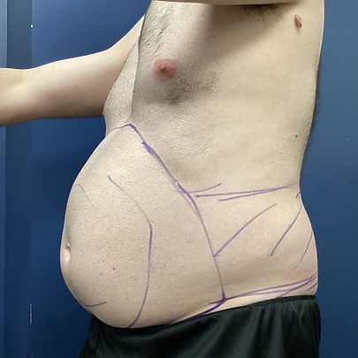 Side view of a man with purple surgical markings on his abdomen, indicating planned areas for a medical procedure.
