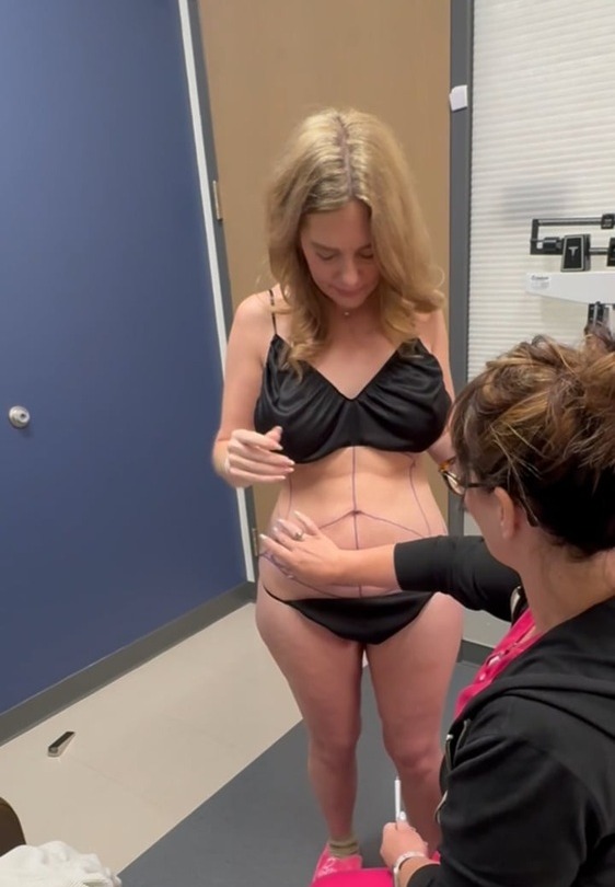 Person in a medical office having lines drawn on their abdomen by a professional, preparing for a procedure.