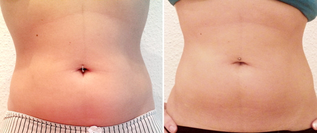 Before and after comparison of a person's abdominal area showing weight loss or skin improvement.