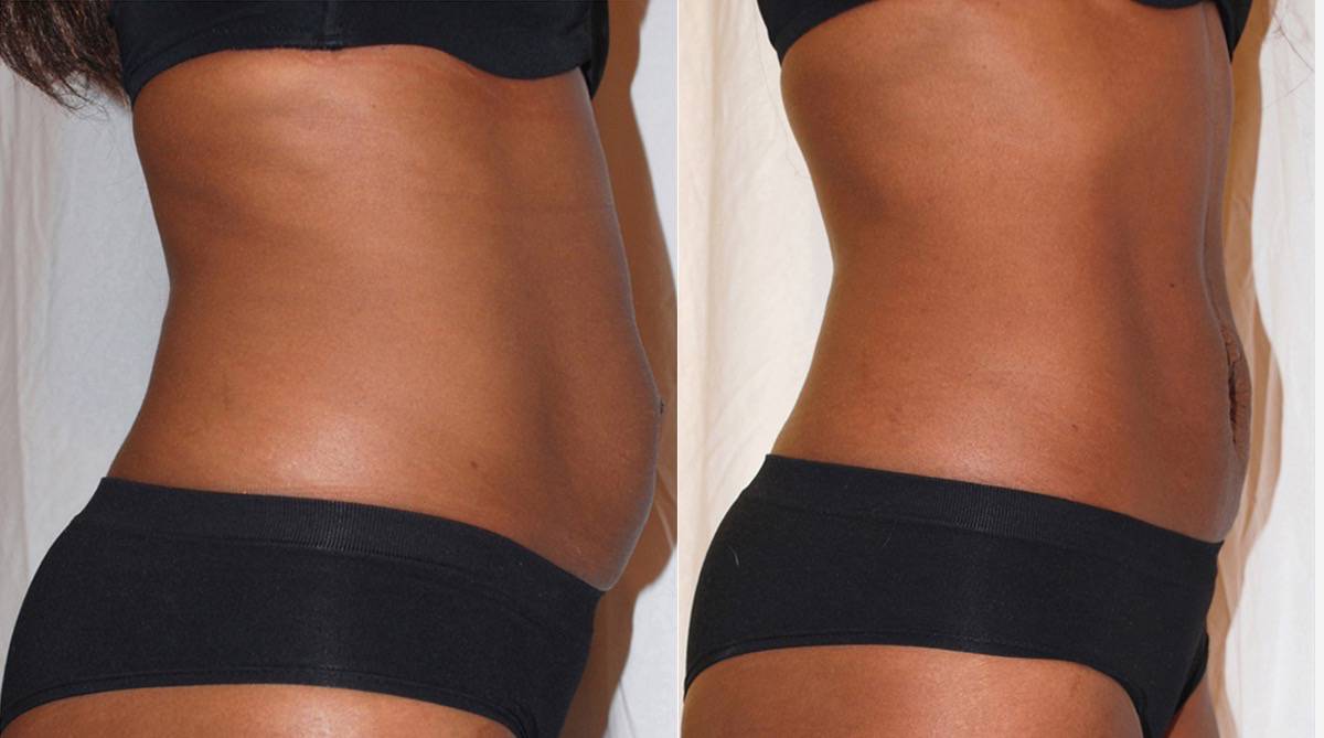 Before and after images showing abdominal changes in a person wearing black shorts.